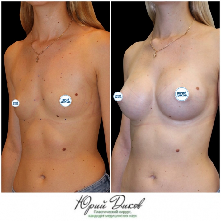 Увеличение груди