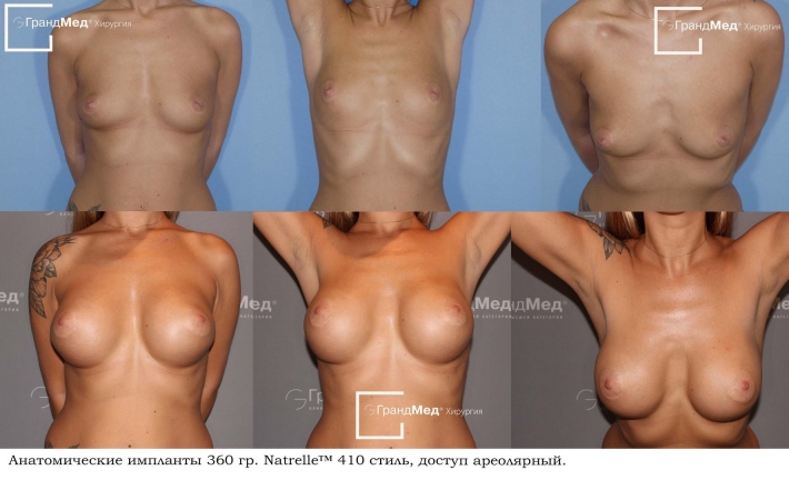 Пластика груди