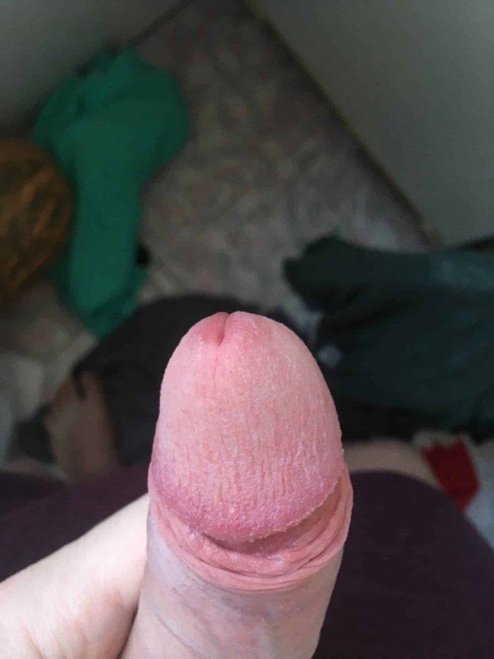 Покраснение головки члена