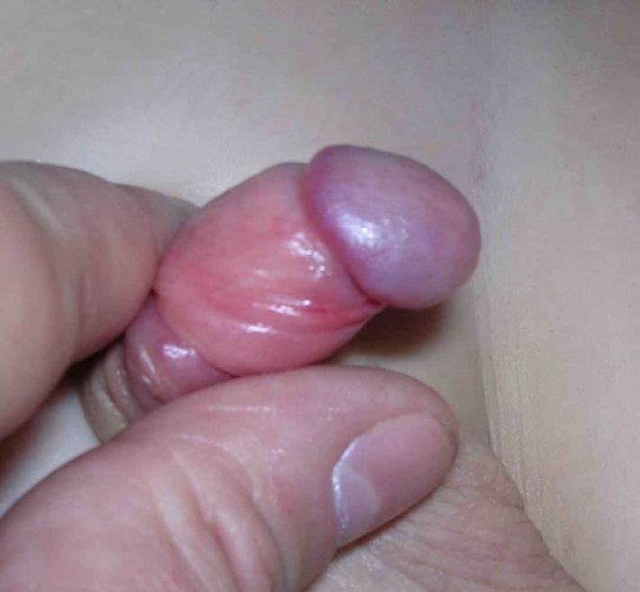 Гипертрофический фимоз