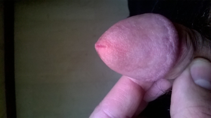 Трещины на головке полового члена