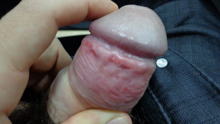 Кандидозный баланопостит