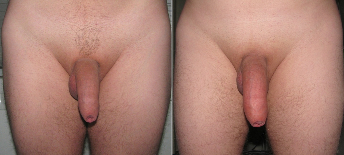 Головчатая гипоспадия